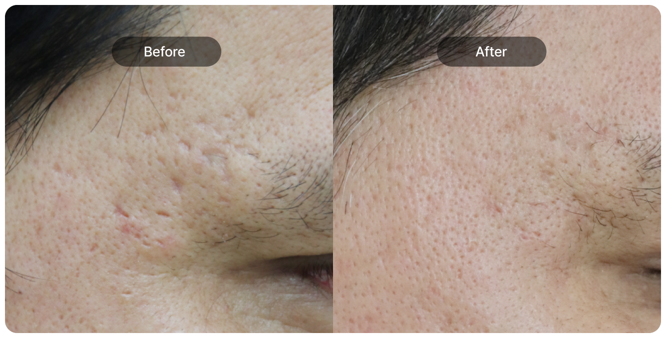 영구적인 치료 효과